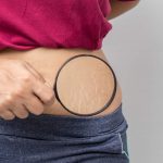 How to Get Rid of Stretch Marks?